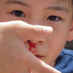 Krwawienia z nosa u dzieci – przyczyny i postępowanie