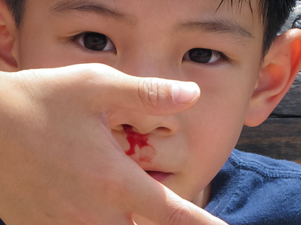 krew z nosa u dziecka