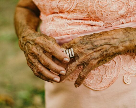 Plamy starcze na dłoniach – skąd się biorą, jak się ich pozbyć?