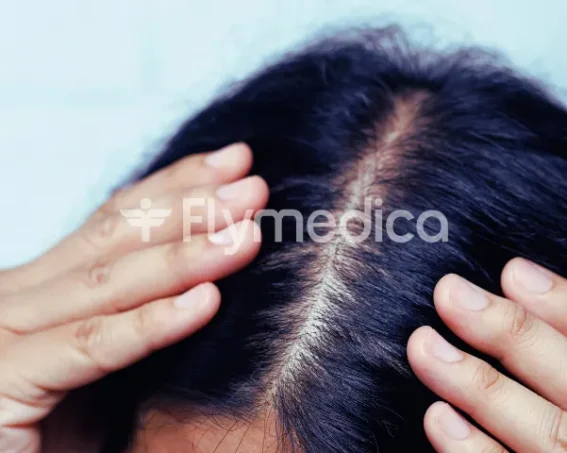 Łysienie trakcyjne – jak się objawia?